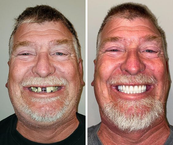 Dental implant before and after - Spring Dental Practice in Hull 5