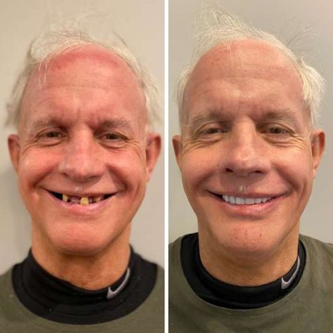 Dental implant before and after - Spring Dental Practice in Hull 6
