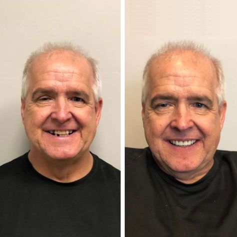 Dental implant before and after - Spring Dental Practice in Hull 2