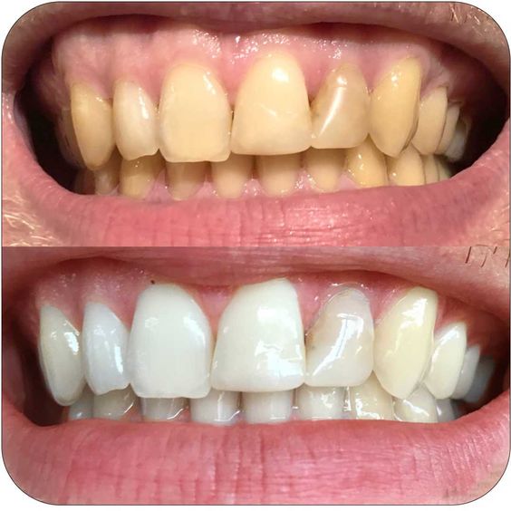 Spring dental teeth whitening in hull