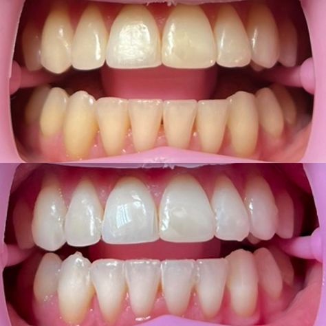 Spring dental teeth whitening in hull1