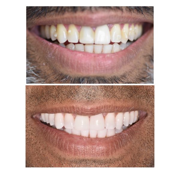 Spring dental teeth whitening in hull3