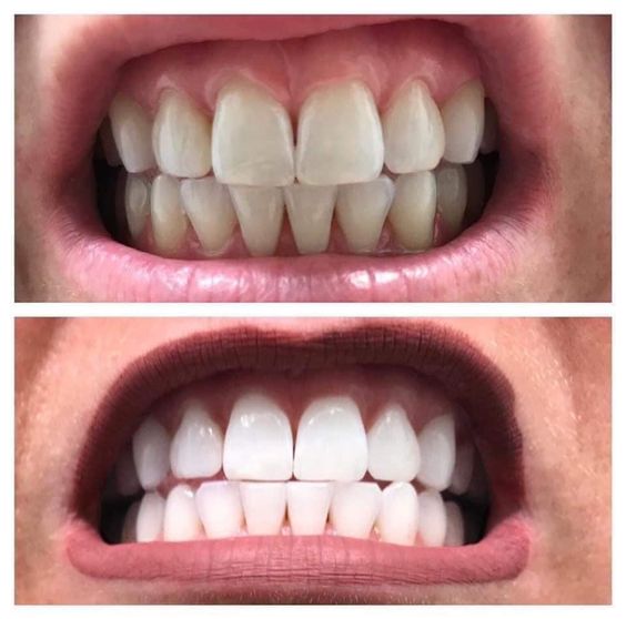 Spring dental teeth whitening in hull4