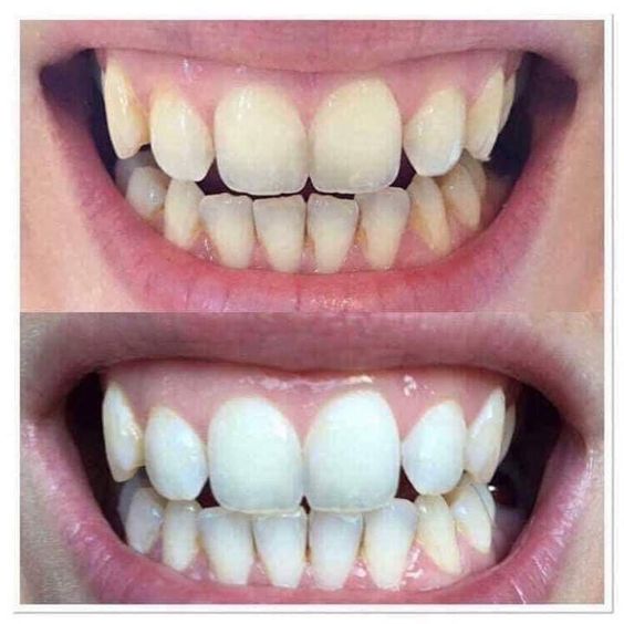 Spring dental teeth whitening in hull5