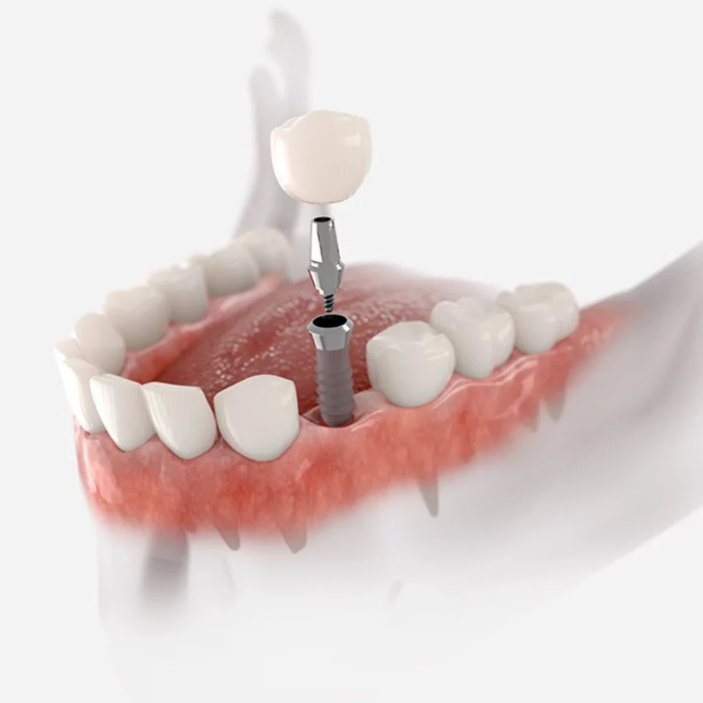 Dental implant 3D image | Spring dental practice in Hull